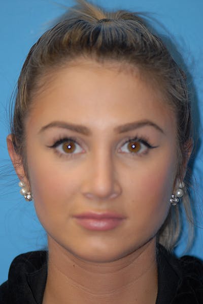 Otoplasty Before & After Gallery - Patient 5883834 - Image 2