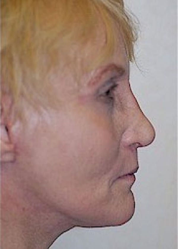 Facelift and Mini Facelift Before & After Gallery - Patient 5883836 - Image 4