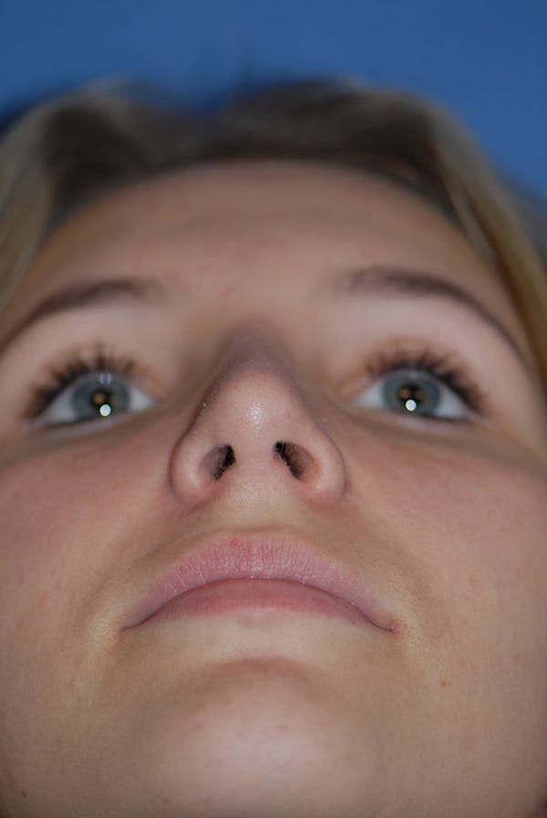 Rhinoplasty Before & After Gallery - Patient 5883835 - Image 8