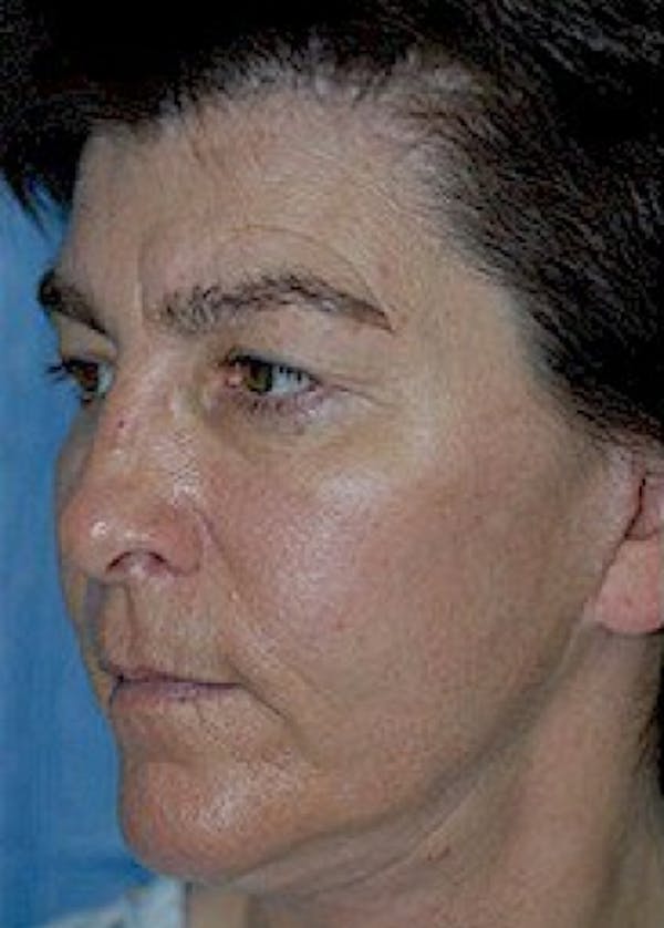 Cheeklift Threadlift Before & After Gallery - Patient 5883837 - Image 1