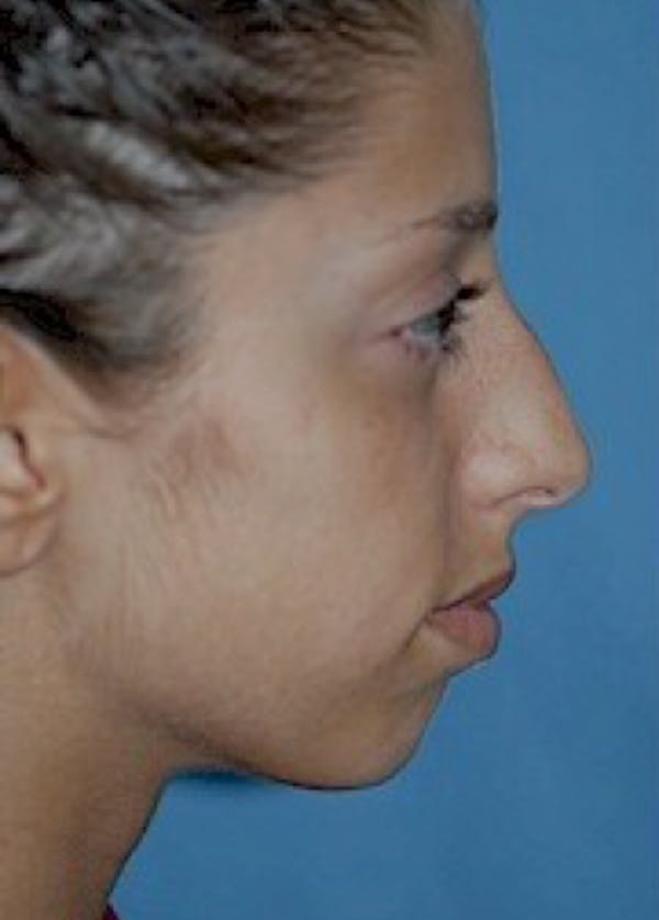 Chin & Cheek Implants Before & After Gallery - Patient 5883839 - Image 1