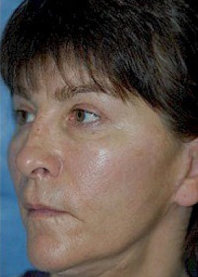 Cheeklift Threadlift Before & After Gallery - Patient 5883837 - Image 2