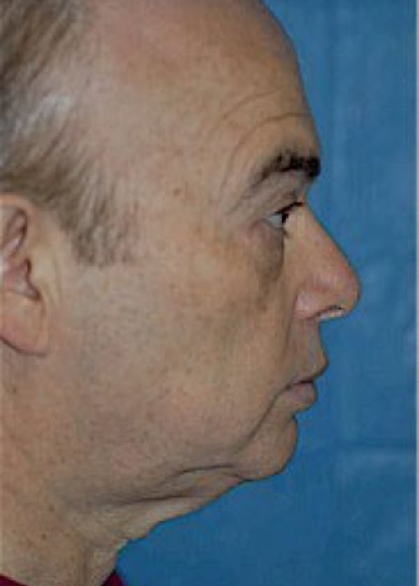 Facelift and Mini Facelift Before & After Gallery - Patient 5883840 - Image 1
