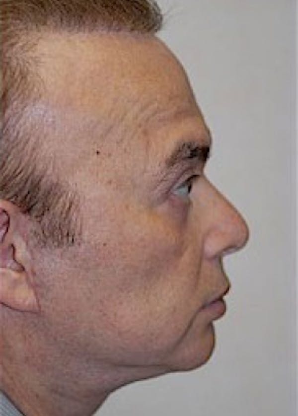 Facelift and Mini Facelift Before & After Gallery - Patient 5883840 - Image 2