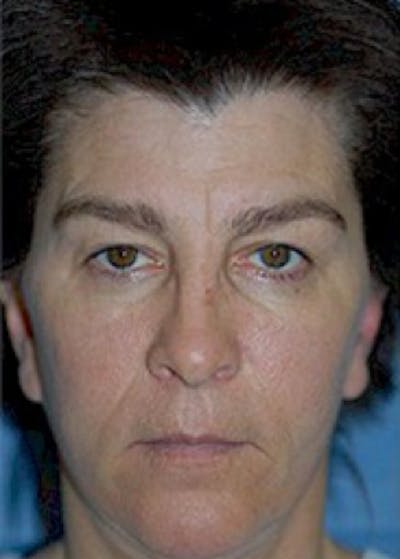 Cheeklift Threadlift Before & After Gallery - Patient 5883841 - Image 1