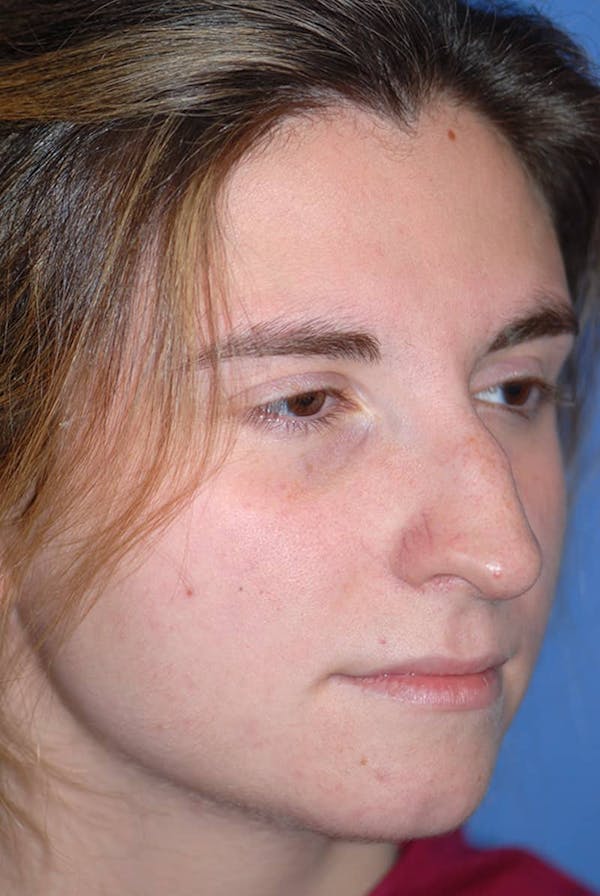 Rhinoplasty Before & After Gallery - Patient 5883848 - Image 3