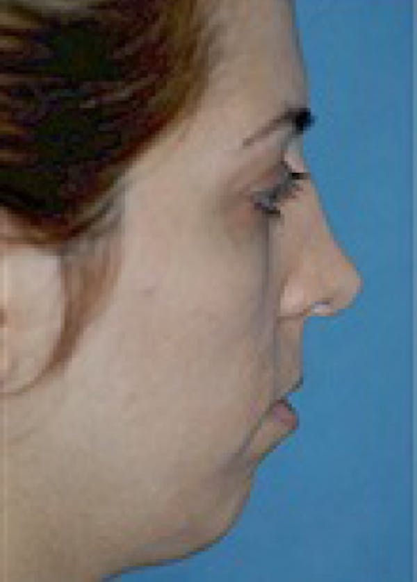 Chin & Cheek Implants Before & After Gallery - Patient 5883845 - Image 1