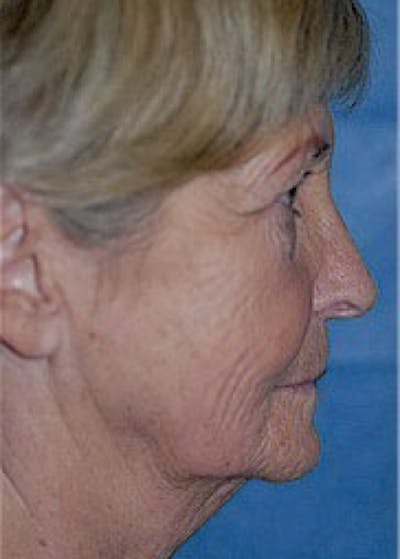 Facelift and Mini Facelift Before & After Gallery - Patient 5883844 - Image 1