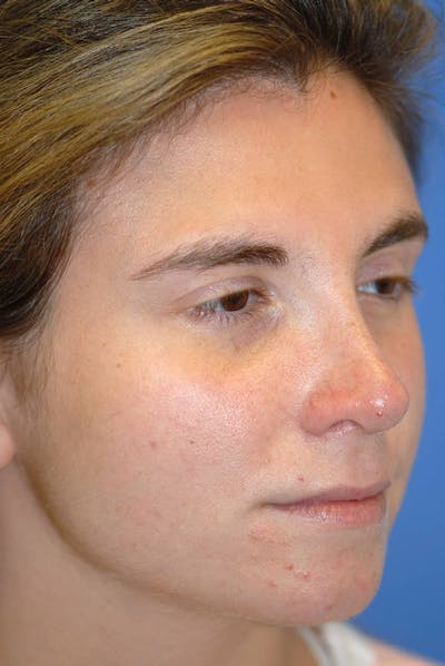 Rhinoplasty Before & After Gallery - Patient 5883848 - Image 4