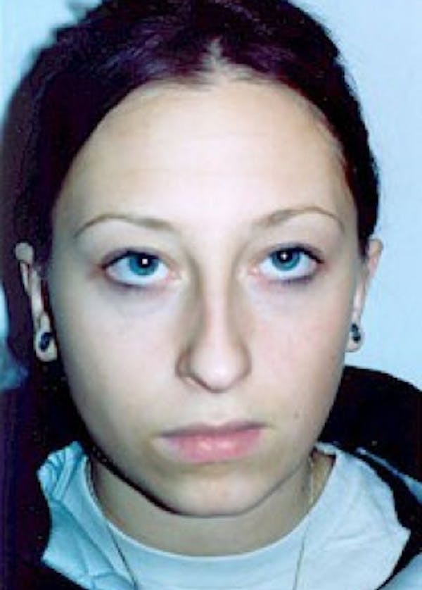 Otoplasty Before & After Gallery - Patient 5883843 - Image 2