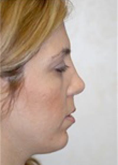 Chin & Cheek Implants Before & After Gallery - Patient 5883845 - Image 2