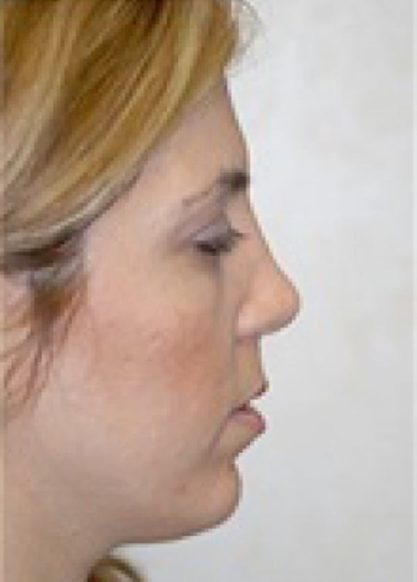 Chin & Cheek Implants Before & After Gallery - Patient 5883845 - Image 2