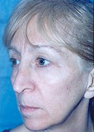Cheeklift Threadlift Before & After Gallery - Patient 5883846 - Image 1