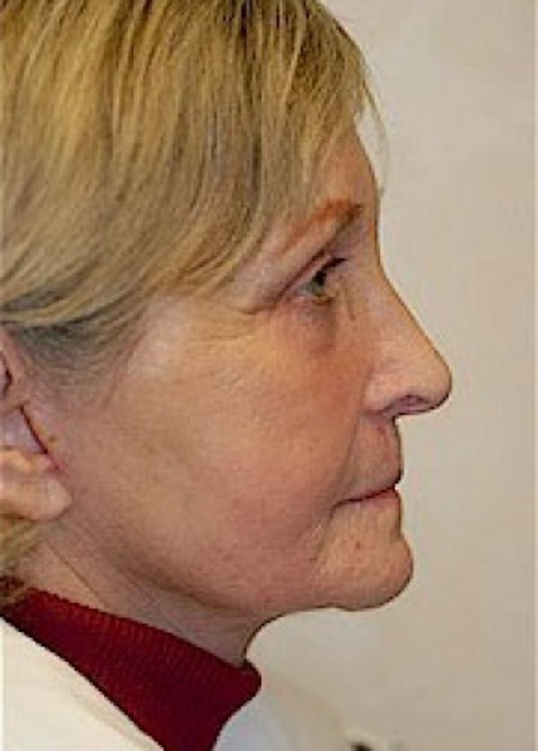 Facelift and Mini Facelift Before & After Gallery - Patient 5883844 - Image 2