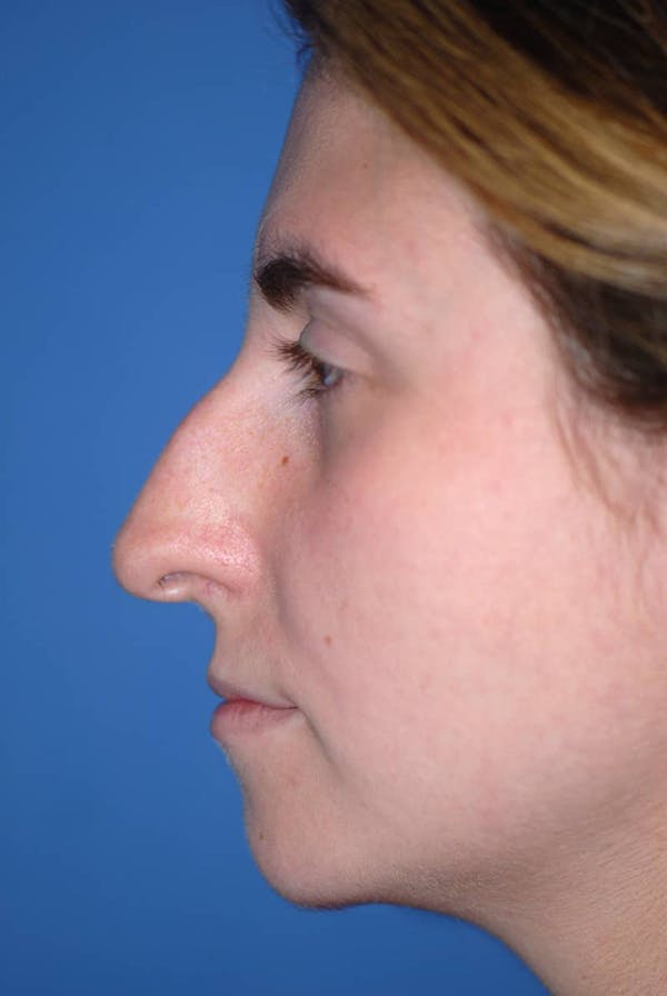 Rhinoplasty Before & After Gallery - Patient 5883848 - Image 5