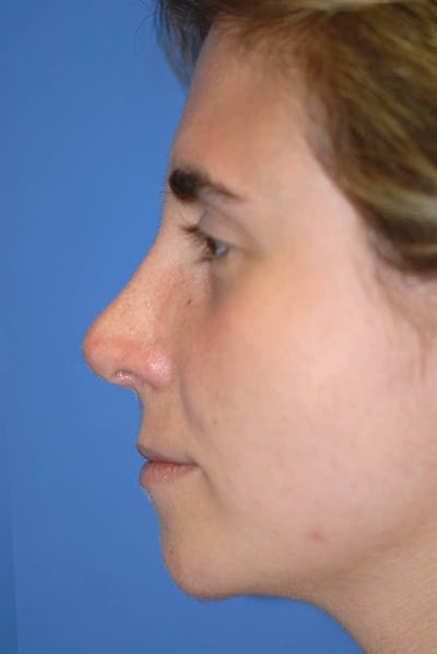 Rhinoplasty Before & After Gallery - Patient 5883848 - Image 6