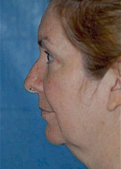 Facelift and Mini Facelift Gallery - Patient 5883847 - Image 1