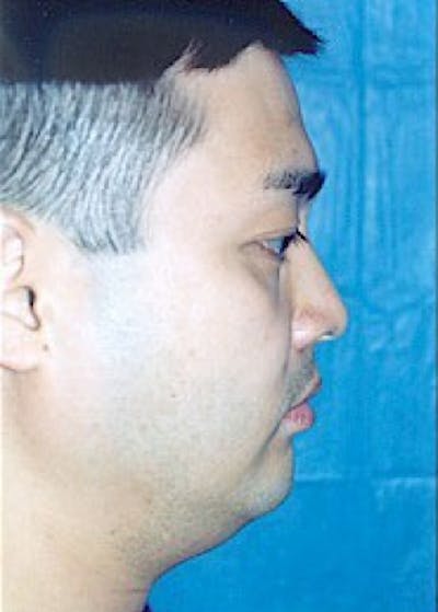 Chin & Cheek Implants Gallery - Patient 5883849 - Image 1