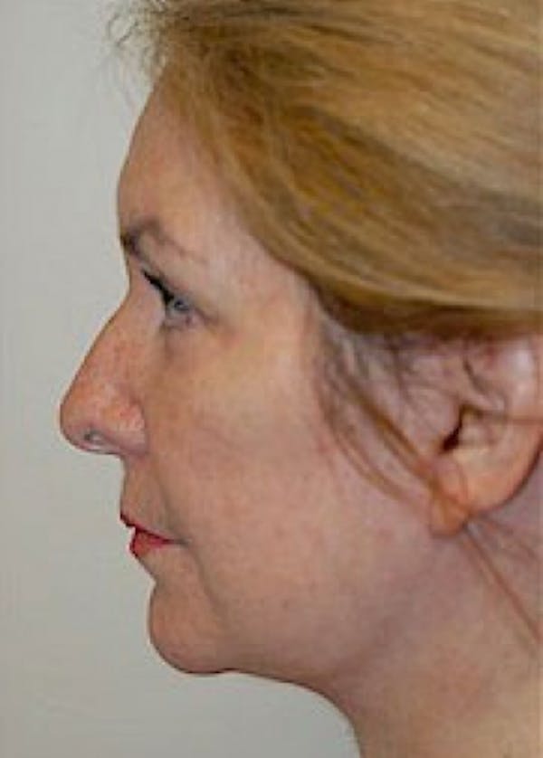 Facelift and Mini Facelift Gallery - Patient 5883847 - Image 2