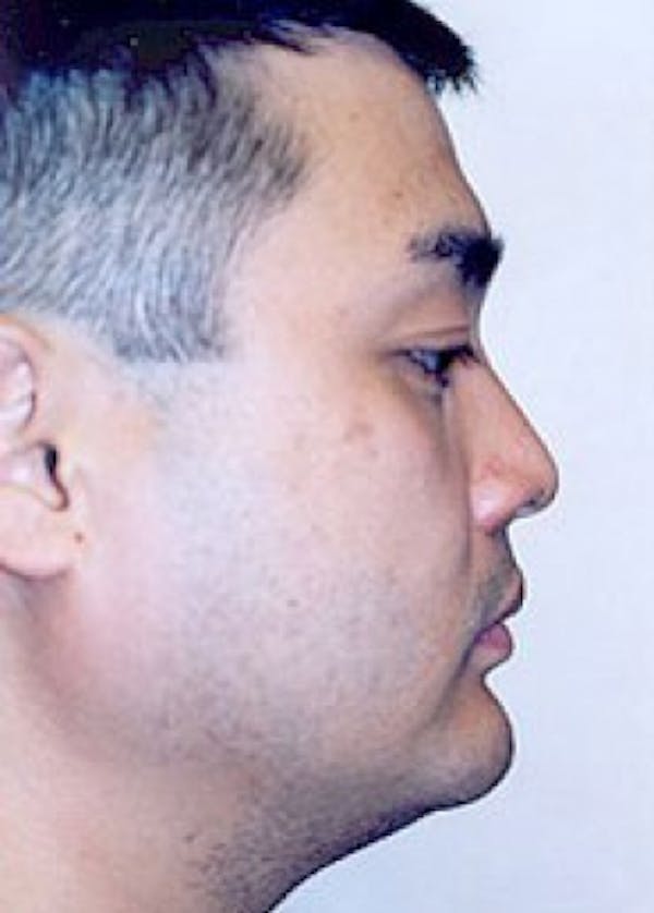 Chin & Cheek Implants Before & After Gallery - Patient 5883849 - Image 2