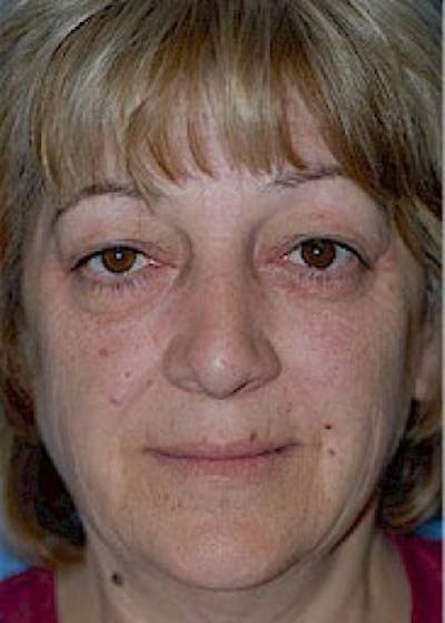Facelift and Mini Facelift Gallery - Patient 5883867 - Image 1