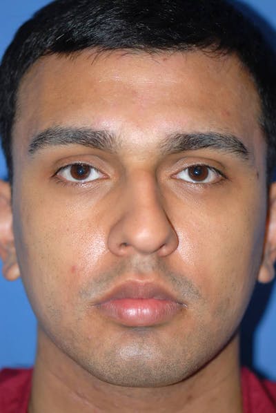 Rhinoplasty Before & After Gallery - Patient 5883869 - Image 1
