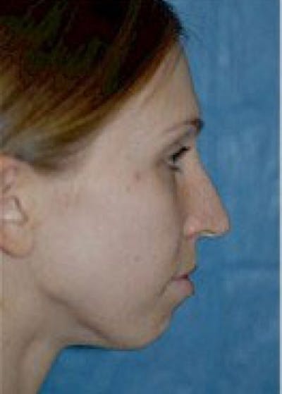 Chin & Cheek Implants Before & After Gallery - Patient 5883861 - Image 1