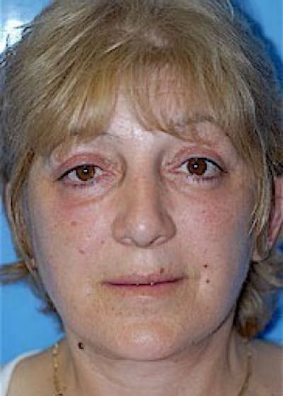 Facelift and Mini Facelift Before & After Gallery - Patient 5883867 - Image 2
