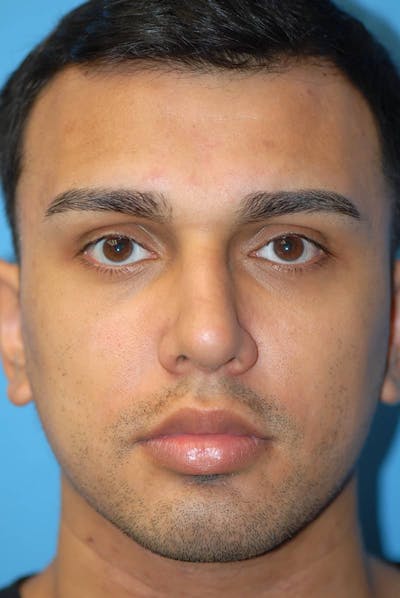 Rhinoplasty Before & After Gallery - Patient 5883869 - Image 2