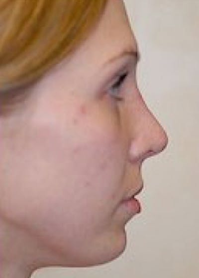 Chin & Cheek Implants Before & After Gallery - Patient 5883861 - Image 2