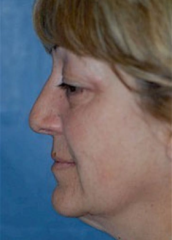 Facelift and Mini Facelift Before & After Gallery - Patient 5883867 - Image 3