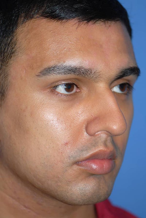 Rhinoplasty Before & After Gallery - Patient 5883869 - Image 3