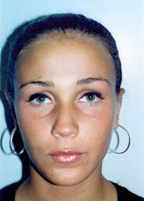 Otoplasty Before & After Gallery - Patient 5883863 - Image 2