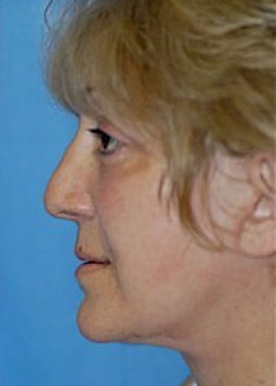Facelift and Mini Facelift Before & After Gallery - Patient 5883867 - Image 4