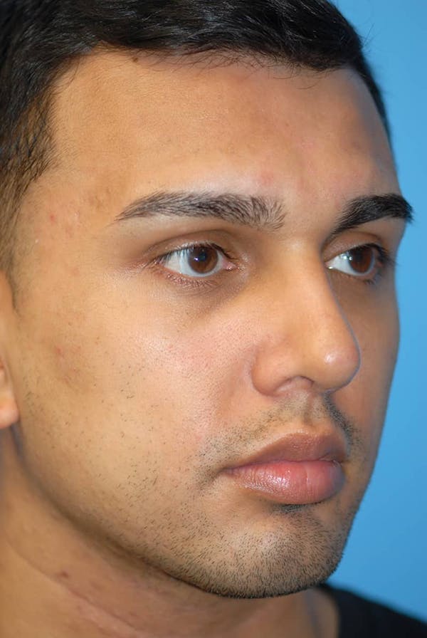 Rhinoplasty Before & After Gallery - Patient 5883869 - Image 4