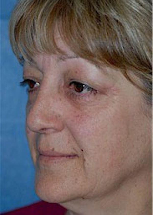 Facelift and Mini Facelift Before & After Gallery - Patient 5883867 - Image 5