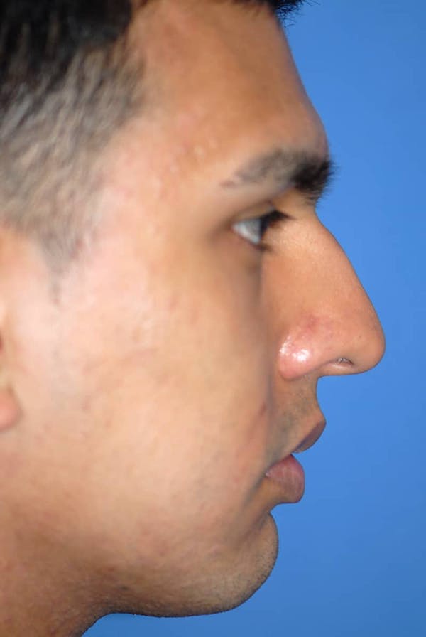 Rhinoplasty Before & After Gallery - Patient 5883869 - Image 5