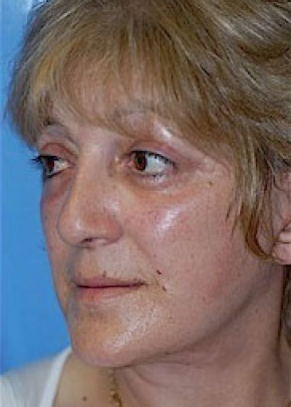 Facelift and Mini Facelift Gallery - Patient 5883867 - Image 6