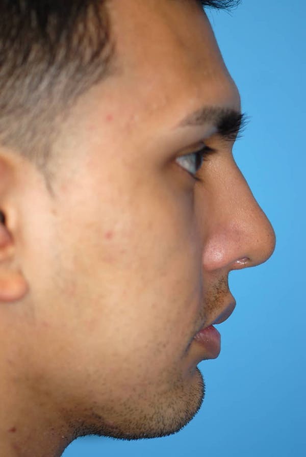 Rhinoplasty Before & After Gallery - Patient 5883869 - Image 6
