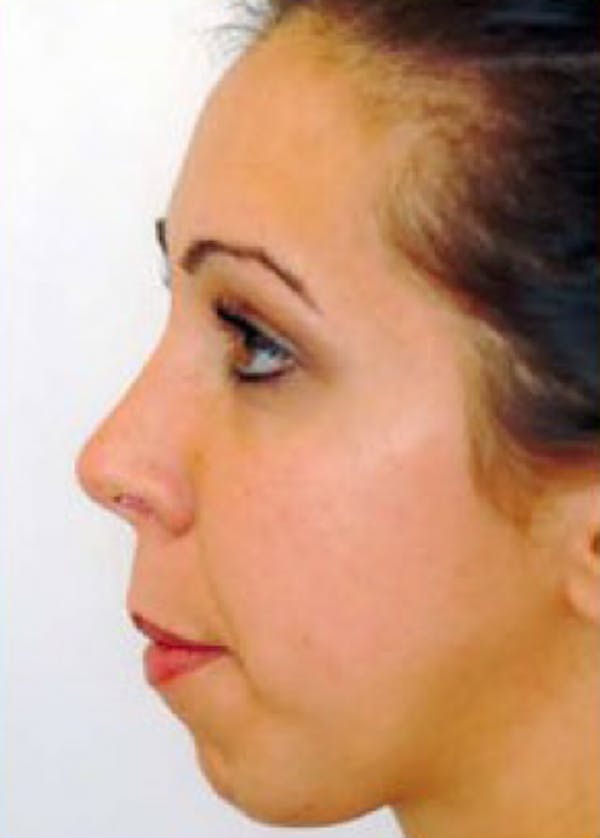 Chin & Cheek Implants Before & After Gallery - Patient 5883873 - Image 1