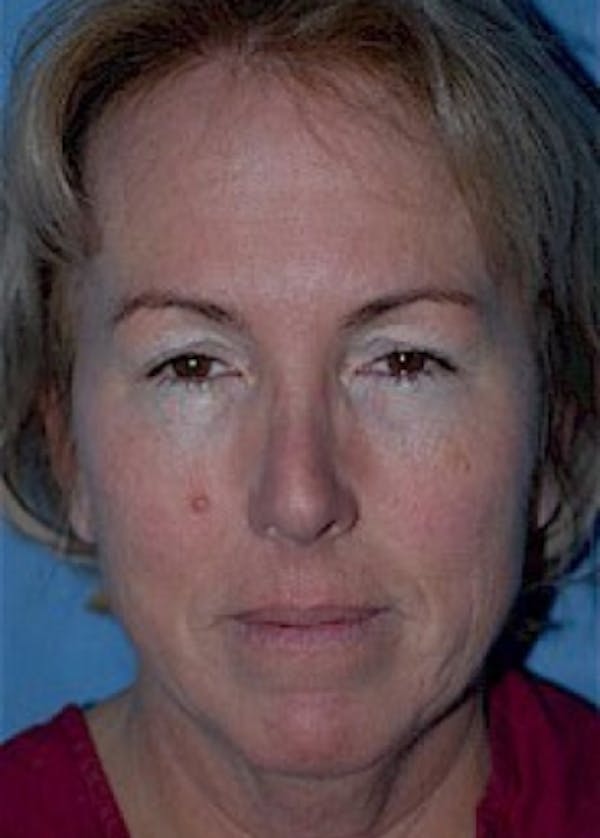 Facelift and Mini Facelift Gallery - Patient 5883875 - Image 1