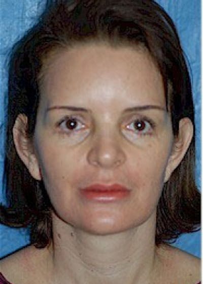 Otoplasty Before & After Gallery - Patient 5883874 - Image 1