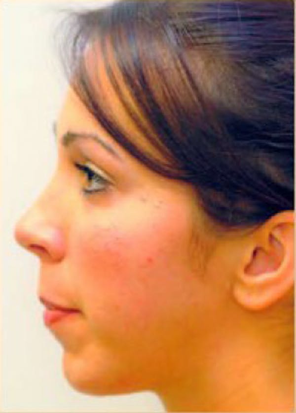 Chin & Cheek Implants Before & After Gallery - Patient 5883873 - Image 2
