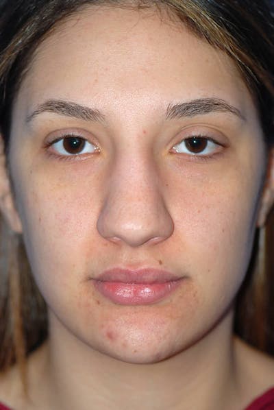 Rhinoplasty Before & After Gallery - Patient 5883880 - Image 1