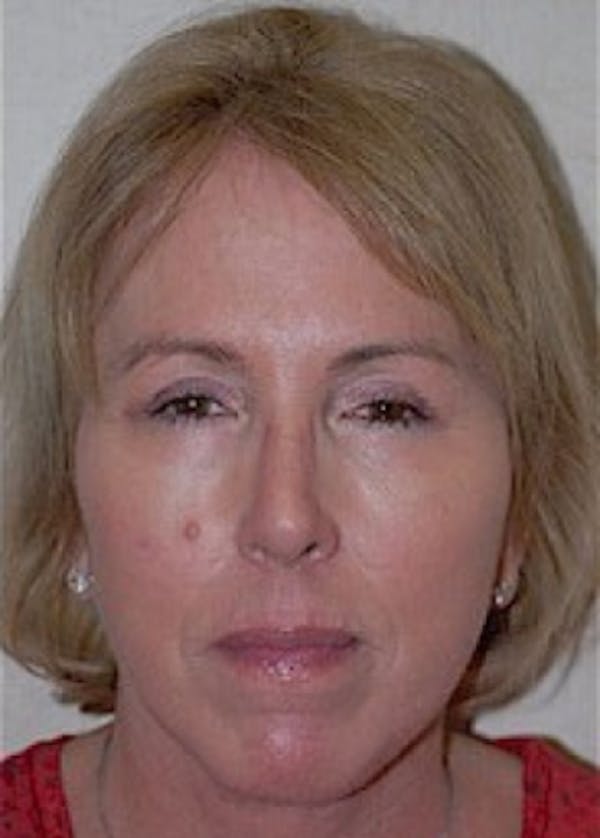 Facelift and Mini Facelift Before & After Gallery - Patient 5883875 - Image 2