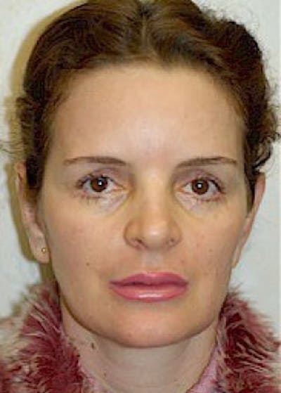 Otoplasty Before & After Gallery - Patient 5883874 - Image 2