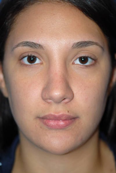 Rhinoplasty Before & After Gallery - Patient 5883880 - Image 2