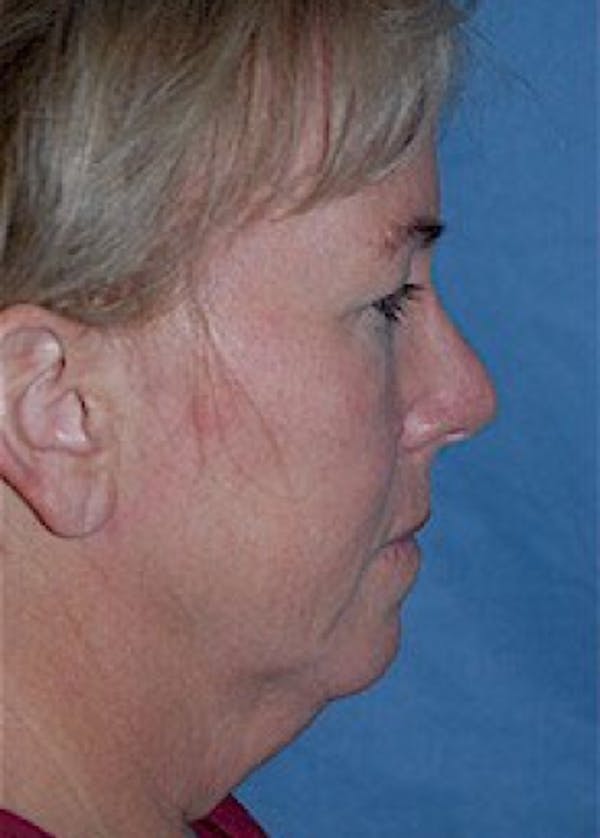 Facelift and Mini Facelift Before & After Gallery - Patient 5883875 - Image 3