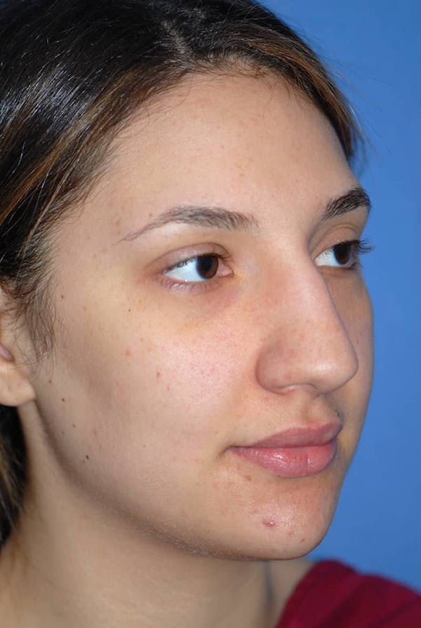 Rhinoplasty Before & After Gallery - Patient 5883880 - Image 3