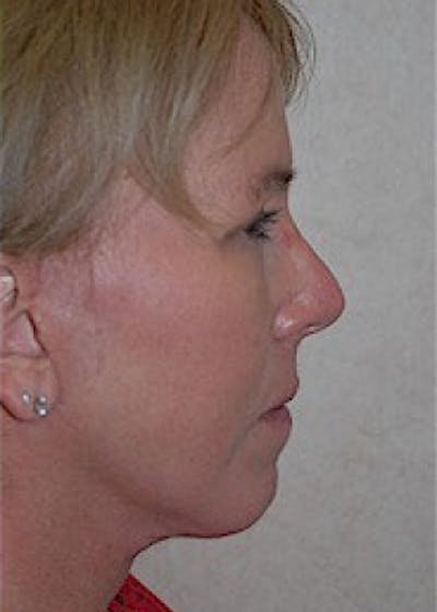 Facelift and Mini Facelift Before & After Gallery - Patient 5883875 - Image 4